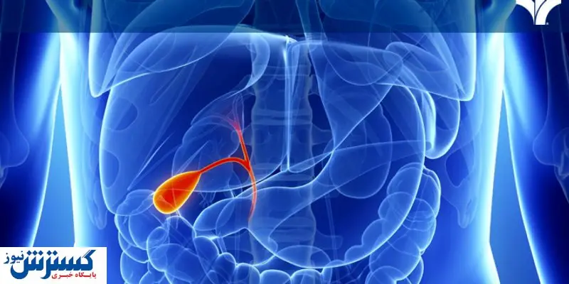 متهم اصلی تشکیل سنگ کیسه صفرا را بشناسیم