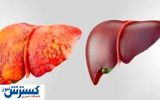 سلاحی مقابل کبد چرب