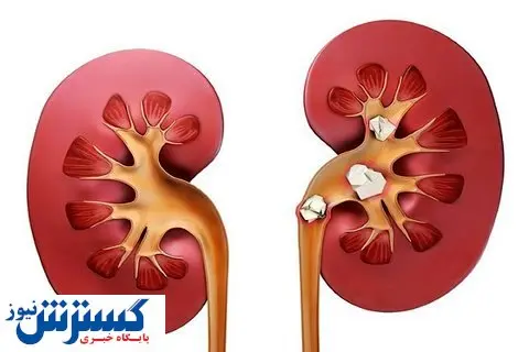 روشهای درمان سنگ کلیه + عکس