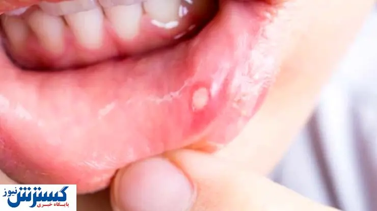 بهترین روش برای بهبود آفت دهان