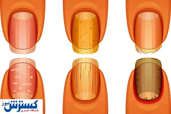 نشانه هایی روی ناخن ها که از سرطان خبر می دهند!