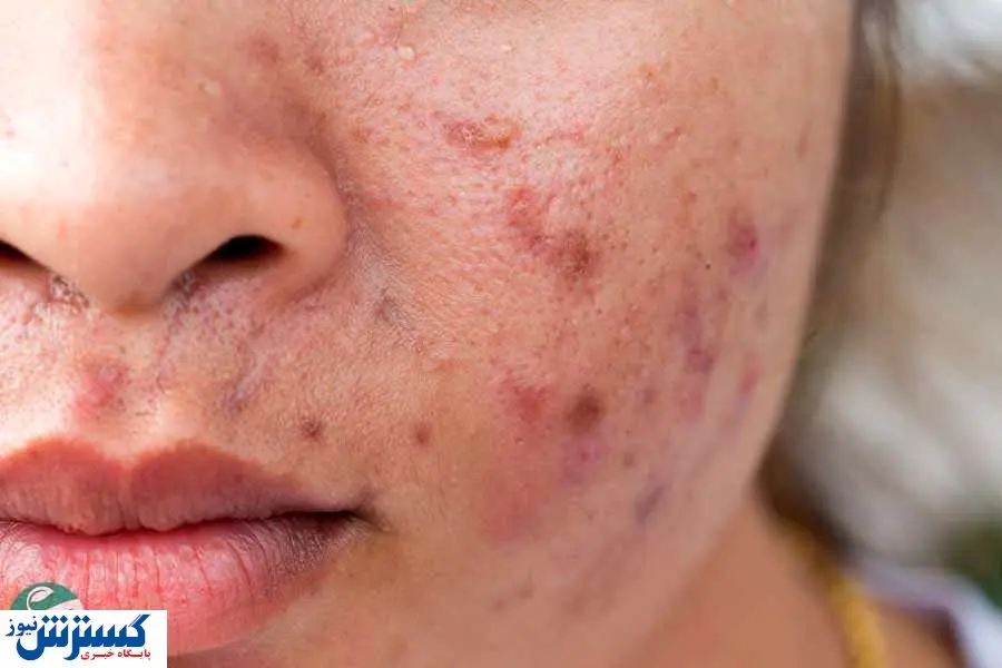 دلیل جوش های سرسیاه چیست؟