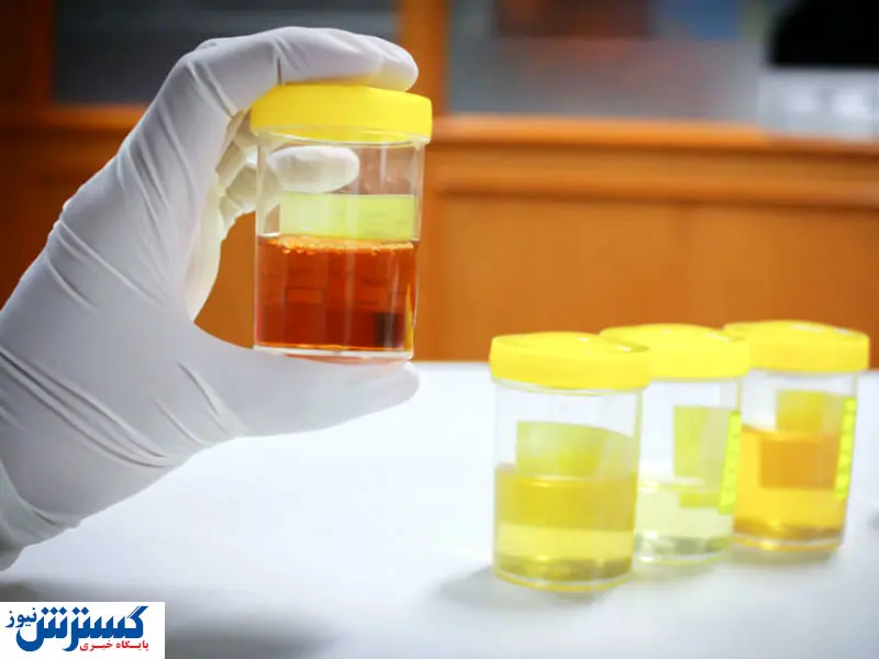 دلایل وجود خون در ادرار