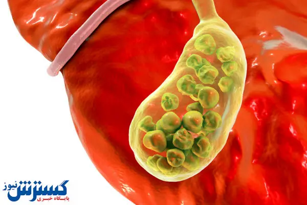 درباره درمان سنگ کیسه صفرا چه می‌دانید؟