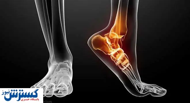 چرا مدام دچار پیچ خوردگی مچ پا می شویم؟