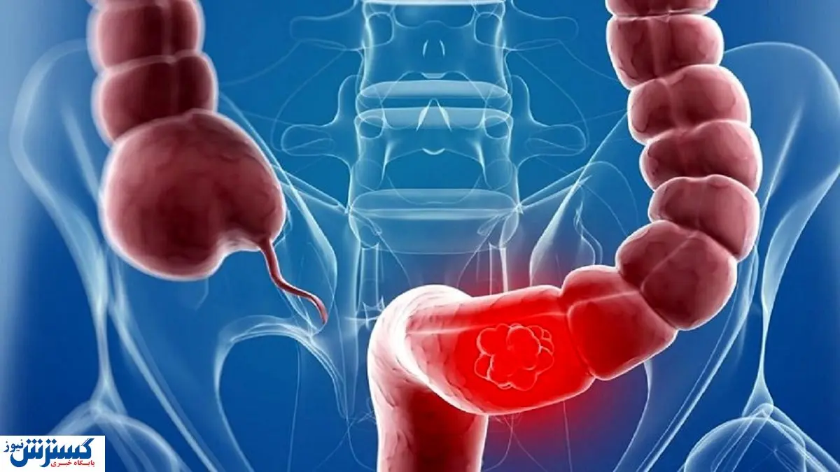 نشانه جدی بیماری سرطان روده‌