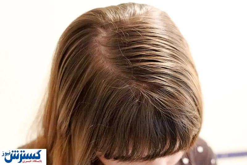 با این رژیم غذایی به جنگ ریزش مو بروید