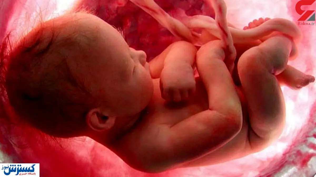 طرح جدید مجلس برای سقط جنین دارای مشکل جسمی