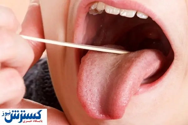 خشکی دهان را درمان کنید تا کرونا نگیرید