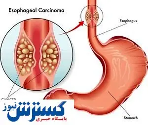 با این روش از بیماری های خطرناک مری جلوگیری کنید