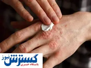 راهکار و روش هایی برای درمان اگزما + نکات مهم و کلیدی