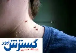 نحوه درمان زگیل در خانه فوری و سریع | نسخه های طب سنتی