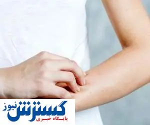 خارش پوست یعنی به این بیماری مبتلا شده اید!
