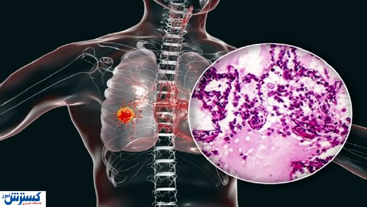۴ نشانه عجیب سرطان ریه که از آن بی خبرید