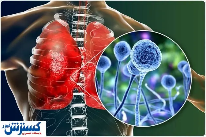 عفونت قارچ سیاه چقدر کشنده است؟