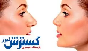 این عوارض را در عمل جراحی بینی جدی بگیرید!