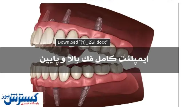 ایمپلنت کامل فک بالا و فک پایین