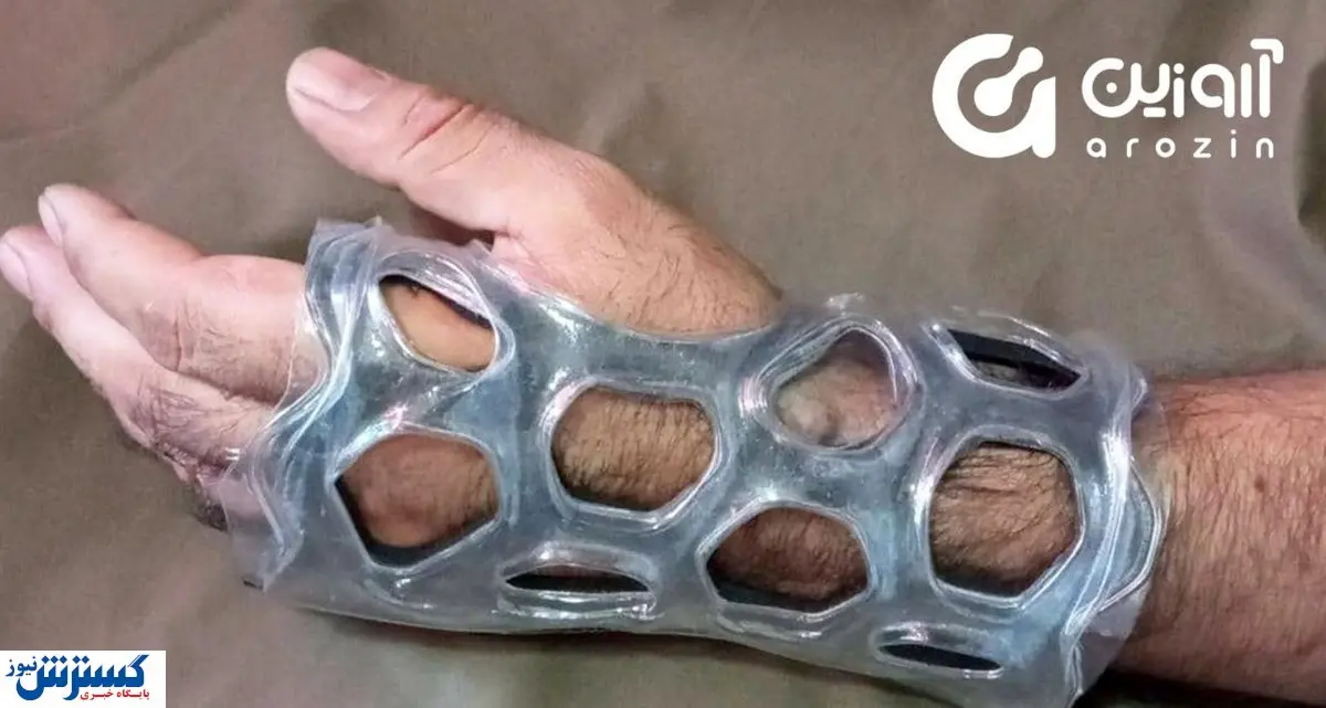 راه‌حل استارتاپ آروزین برای رفع مشکلات گچ‌های پلی‌استر در شکستگی اندام