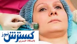 میکرونیدلینگ