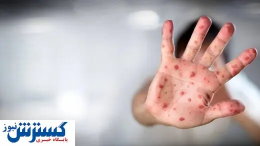 آخرین وضعیت آبله میمونی در دنیا