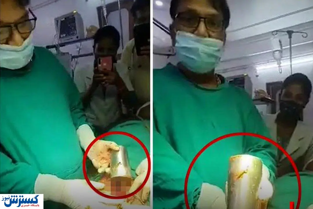 کشف لیوان فولادی در شکم این مرد + عکس