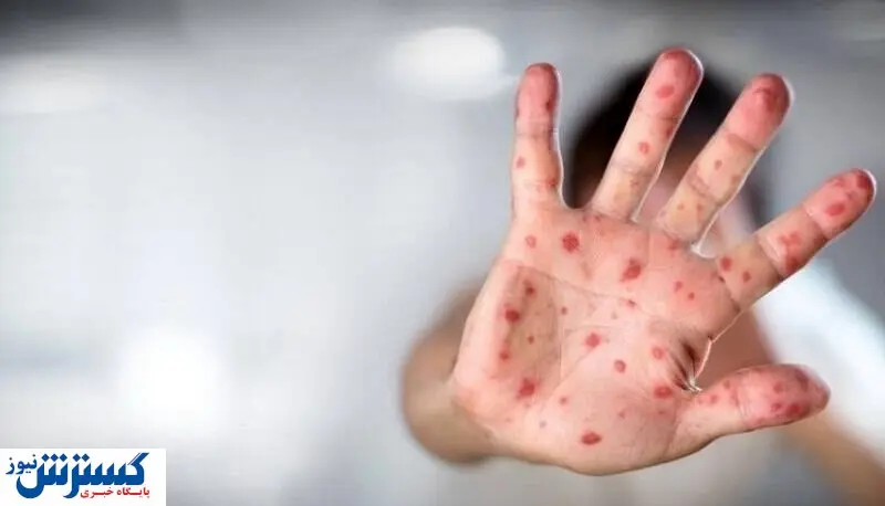 آخرین وضعیت آبله میمونی در کشور/ آبله میمون در اروپا ریشه کن شد؟