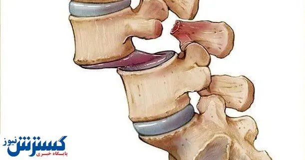 ۰ تا ۱۰۰ جراحی سرخودرگی مهره کمر در تهران بدون عوارض