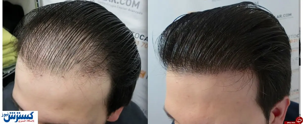 کاشتی  با برداشتی عجیب از جیب تان/قدر موهای میلیونی خود را بدانید