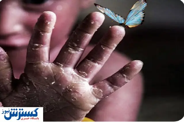 خط تولید محصول حیاتی بیماران پروانه ای در کشور راه اندازی شد