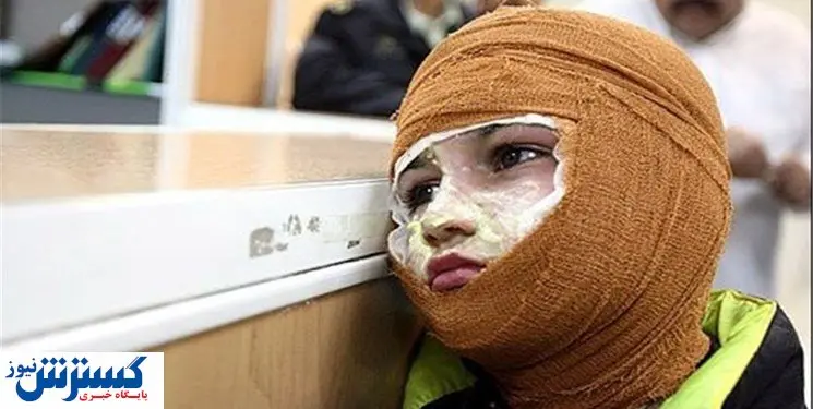 بررسی هزینه درمان سوختگی با بیمه سلامت/پرداخت از صندوق بیماران صعب العلاج