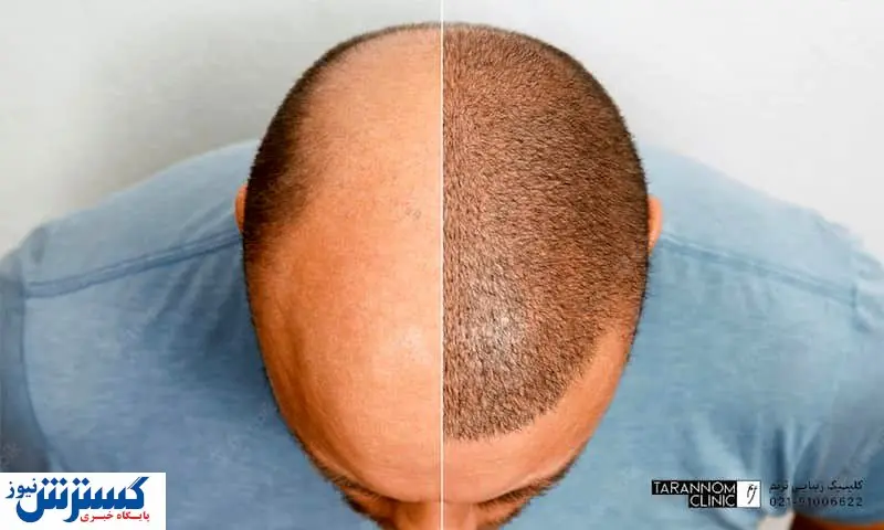 چه کسانی نمی توانند کاشت مو انجام دهند؟