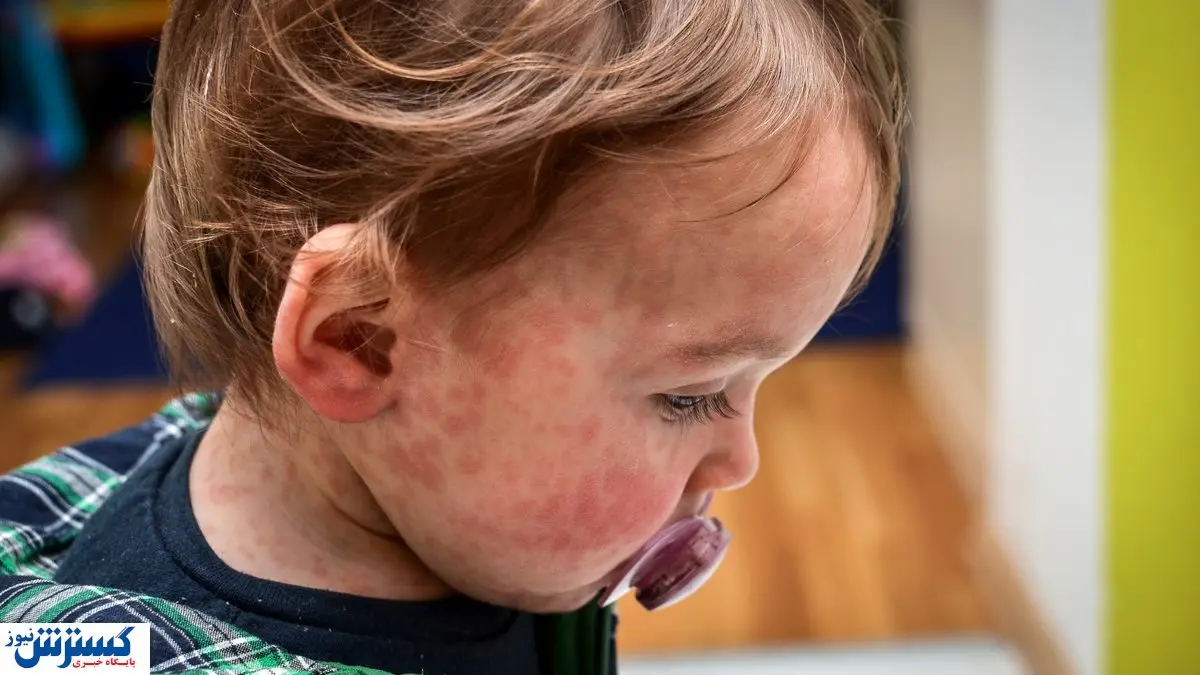 آلرژی در برخی موارد باعث مرگ می شود! / راهکار چیست؟