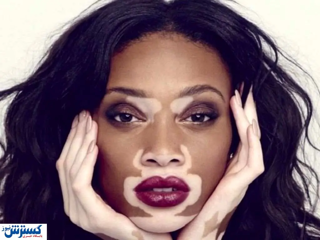 ارائه روش درمان جدید این بیماری پوستی