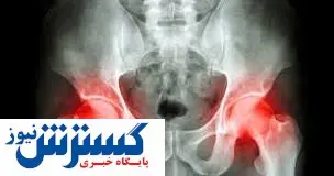 شایعترین علامت  سرطان لگن مشخص شد