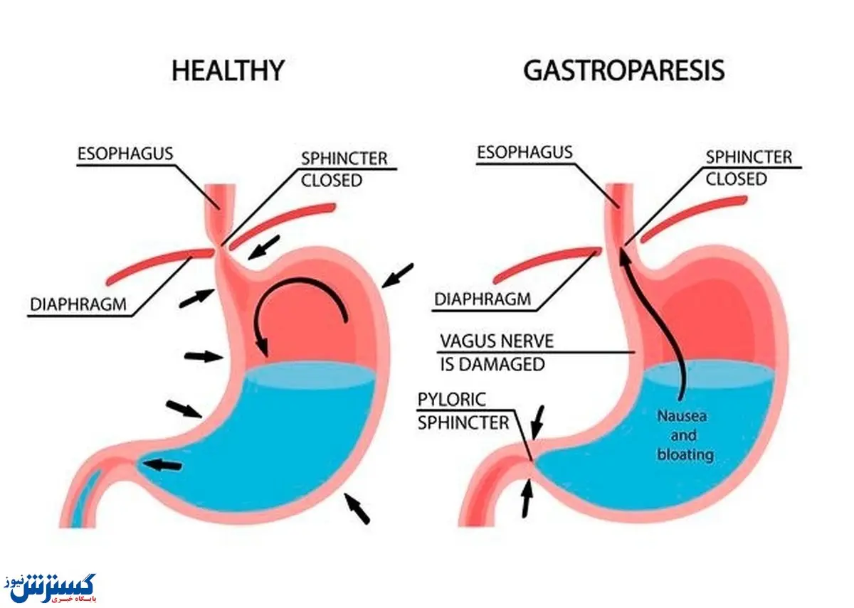 هشدار | با این علائم ممکن است معده شما فلج شود