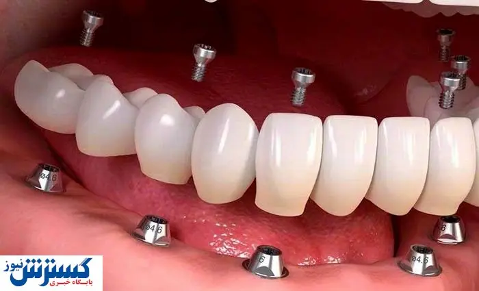 ایمپلنت در کرج