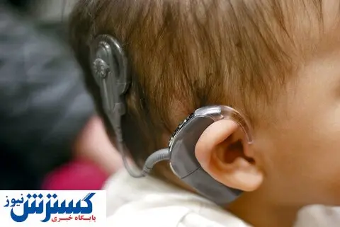 کاشت حلزون رایگان شد / در کدام بیمارستان ها جراحی رایگان است؟