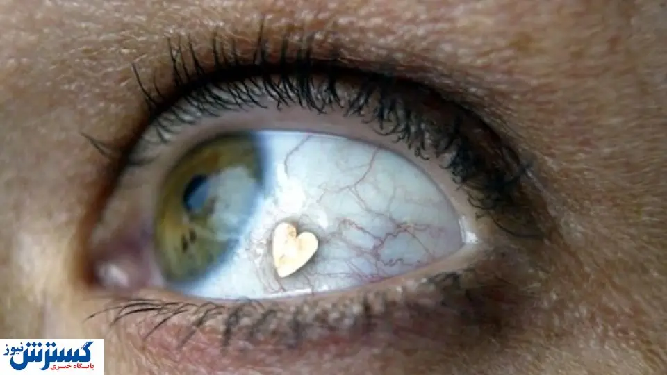 هزینه های هنگفت عمل های غیر ضروری چشم/ اکسسوری داخل چشم  ۳۰۰ میلیون هزینه دارد