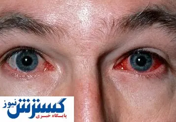 صفر تا صد کرونای چشمی | این افراد بیشتر مراقبت کنند