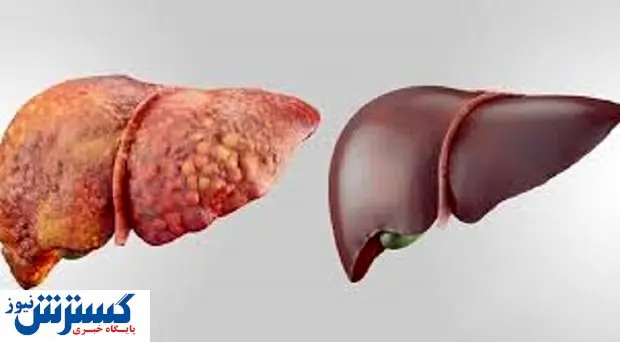 قاتل کبد چرب در طب سنتی شناسایی شد