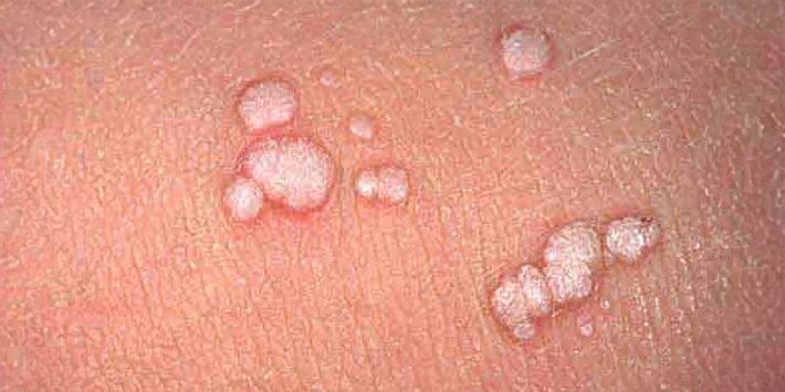 آیا زگیل تناسلی واگیر دارد؟ حقایق علمی درباره انتقال، پیشگیری و HPV