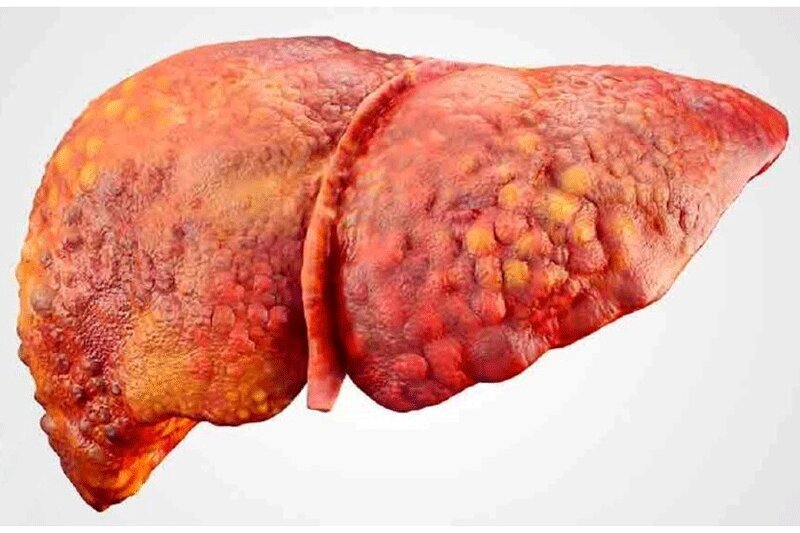 کبد چرب؟ | با چند گام آسان آن را درمان و پاکسازی کنید