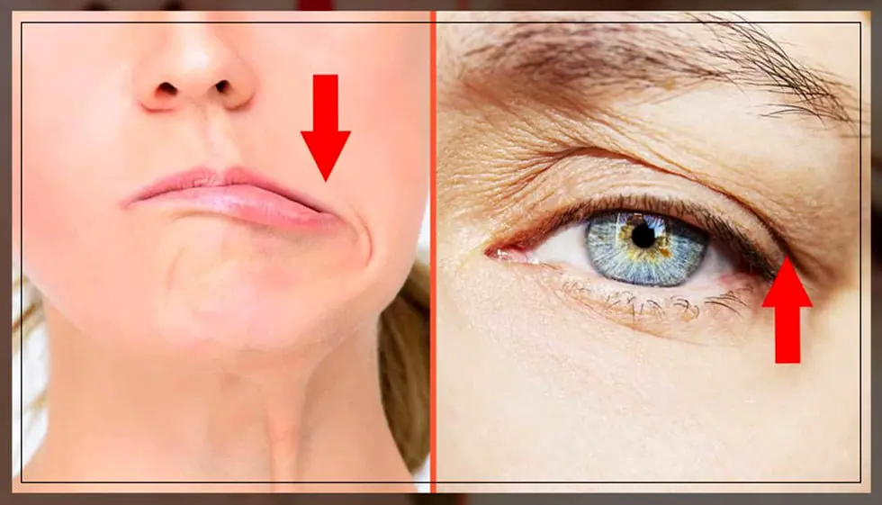 بوتاکس برای چه کسانی ضرر دارد؟ موارد منع مصرف، خطرات و عوارض جانبی