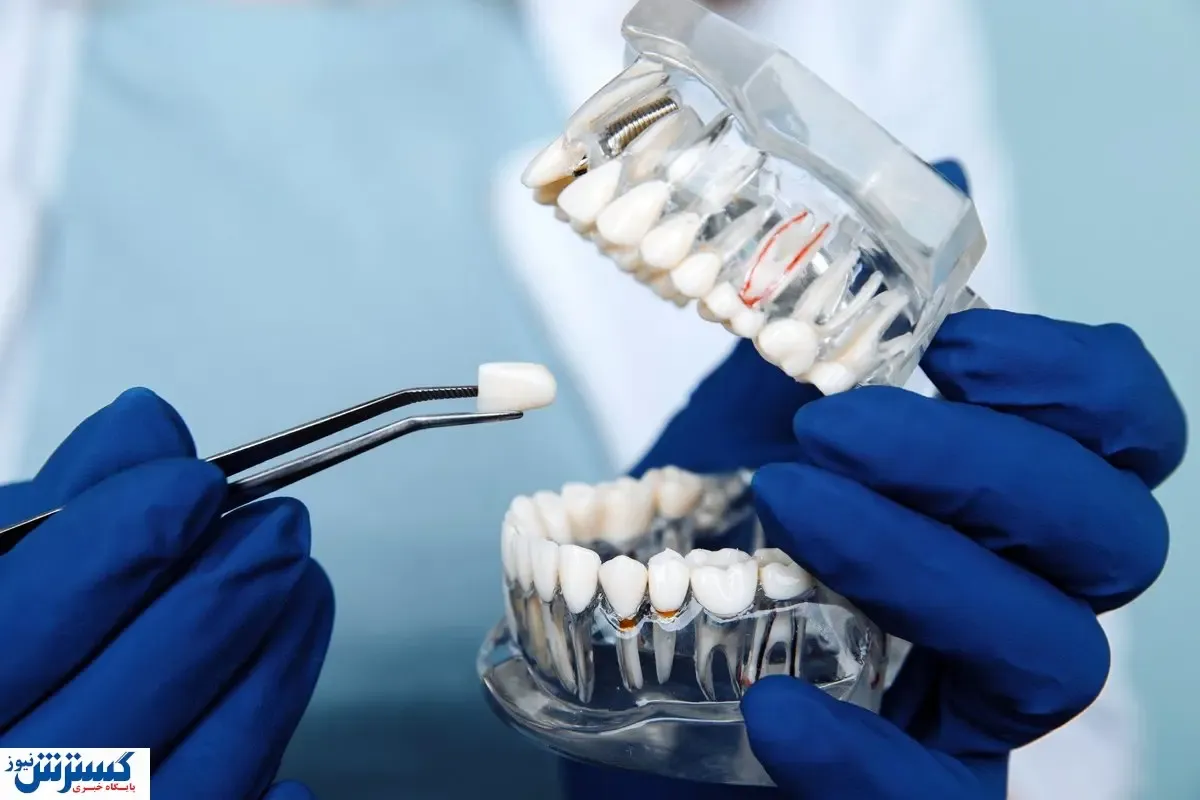 تعرفه‌های ۱۴۰۴ خدمات دندان پزشکی اعلام شد | کامپوزیت هر فک چند ؟