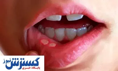 کمبود این ویتامین ها باعث آفت دهان می‌ شود