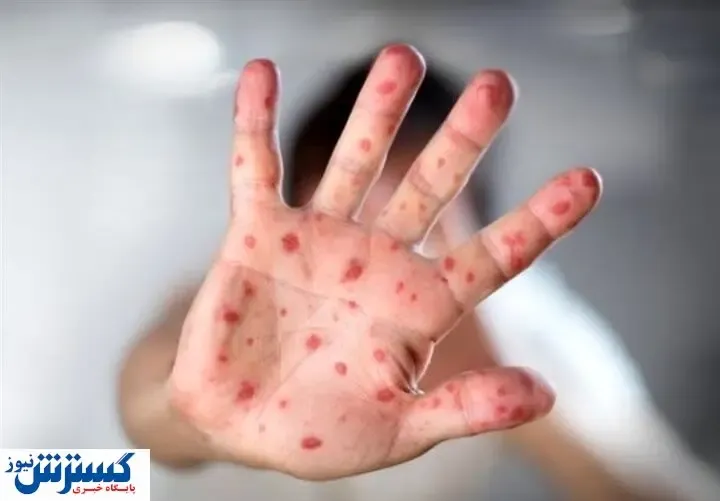 هشدار بیماری | اتباع افغان و پاکستان سوغاتی تازه آوردند !