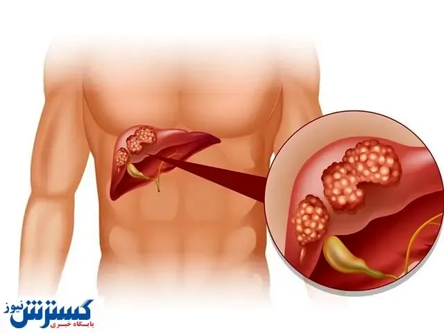 سگ عامل انتقال این بیماری خطرناک/کیست هیداتید