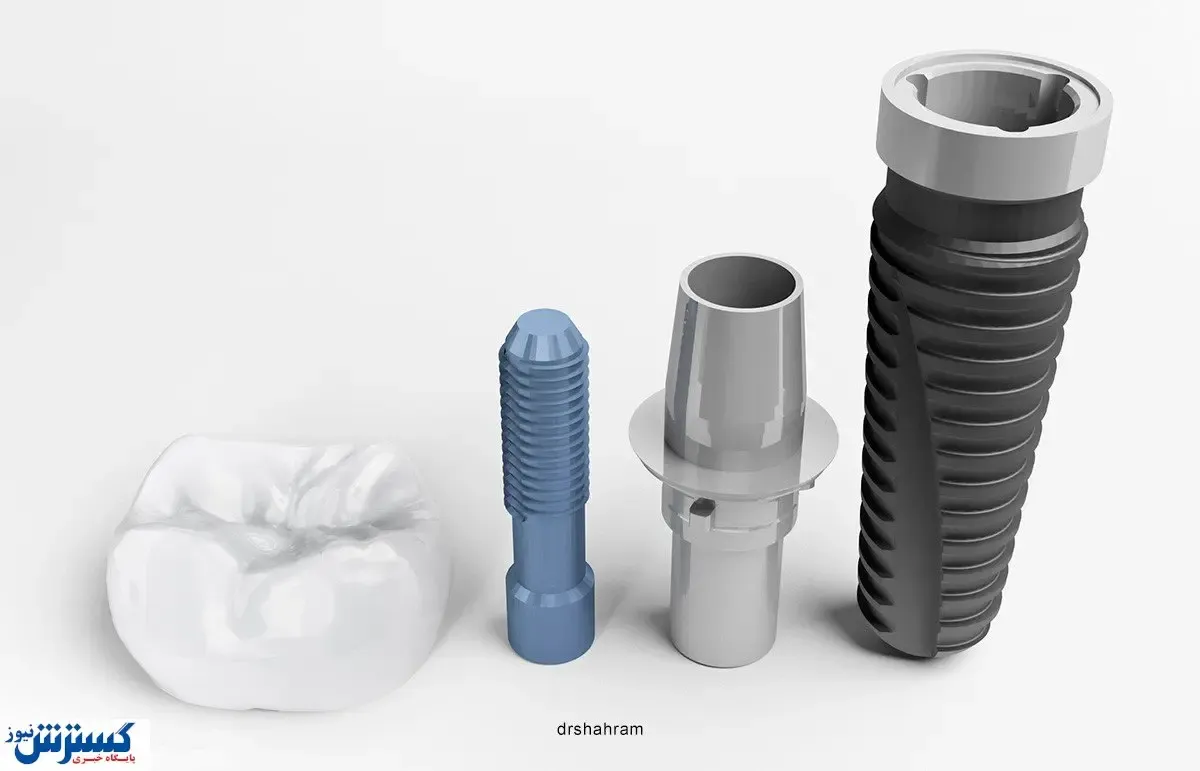 آشنایی با انواع ایمپلنت و قطعات ایمپلنت دندانی