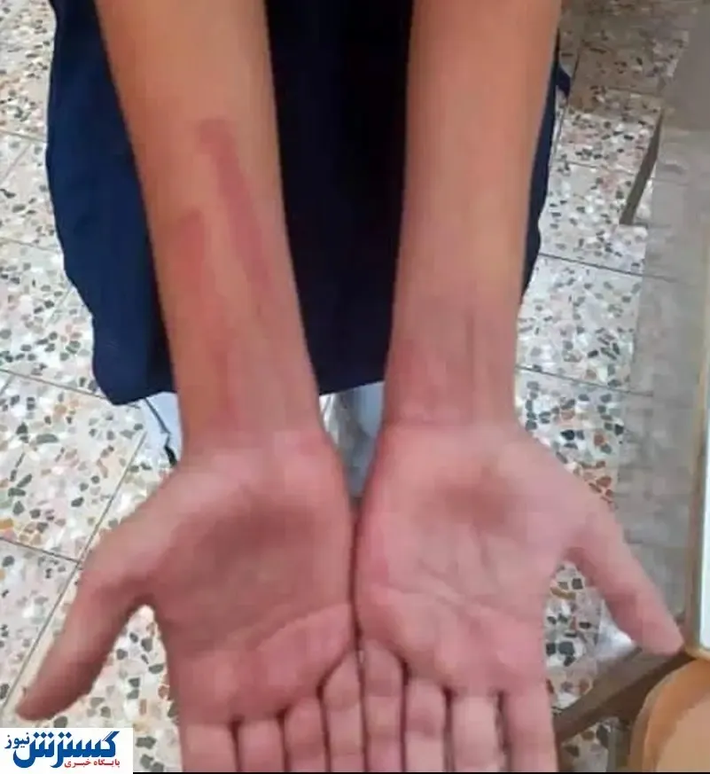 کتک زدن دانش آموزی دیگر در آستارا | واکنش فوری آموزش و پرورش