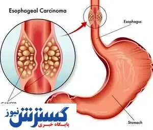 با این روش از بیماری های خطرناک مری جلوگیری کنید